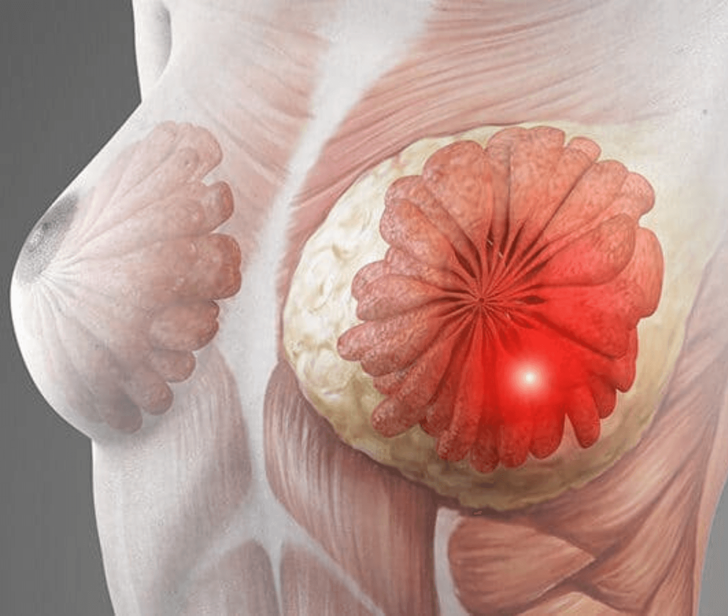 Breast Cancer