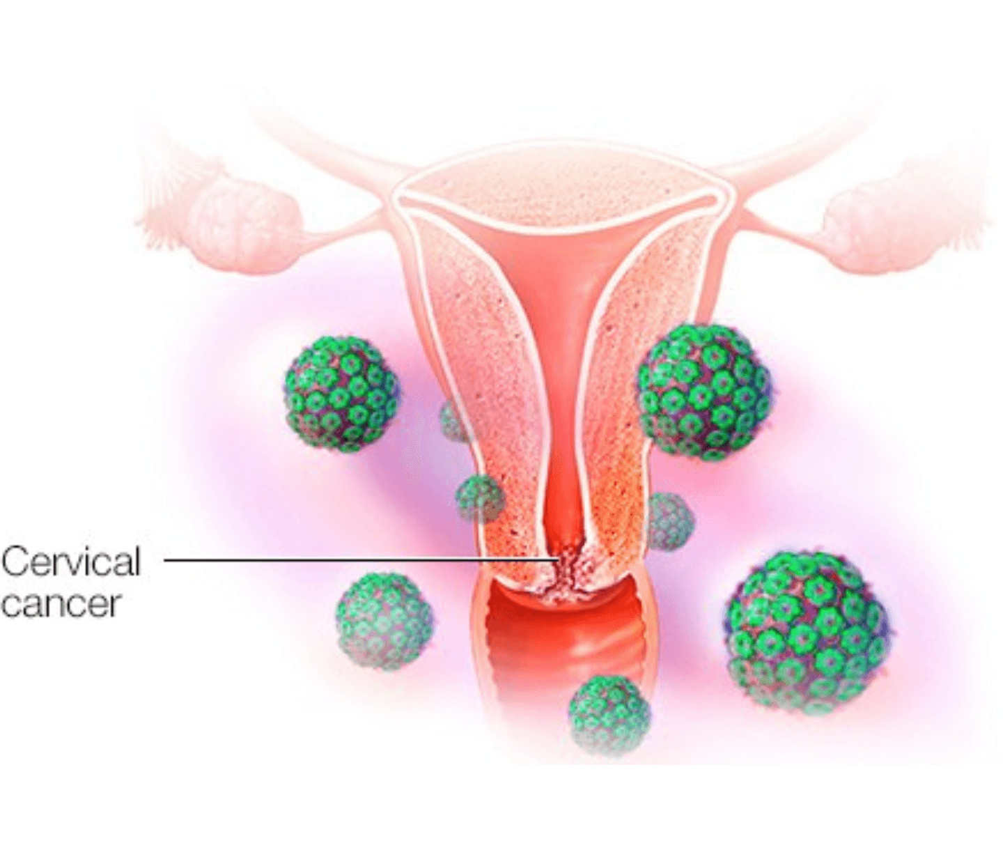 Cervical & Uterine Cancer