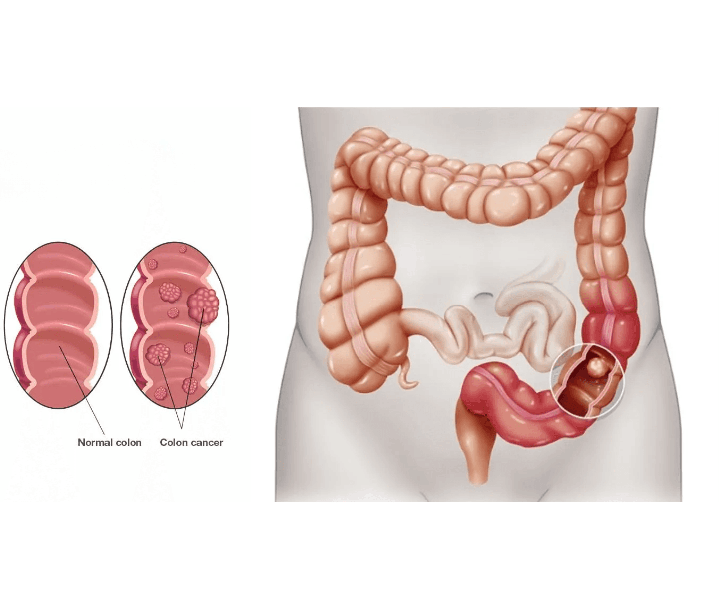 Colorectal Cancer