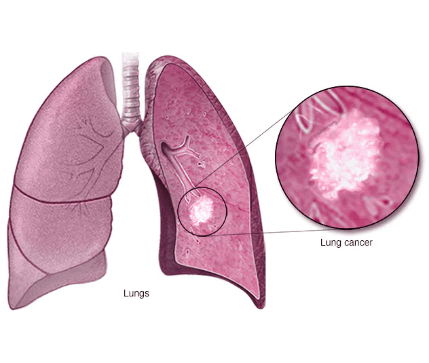 Lung Cancer
