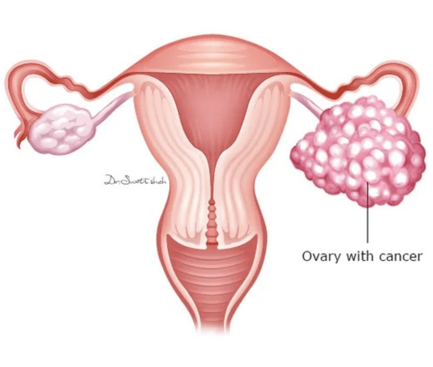 Ovarian Cancer
