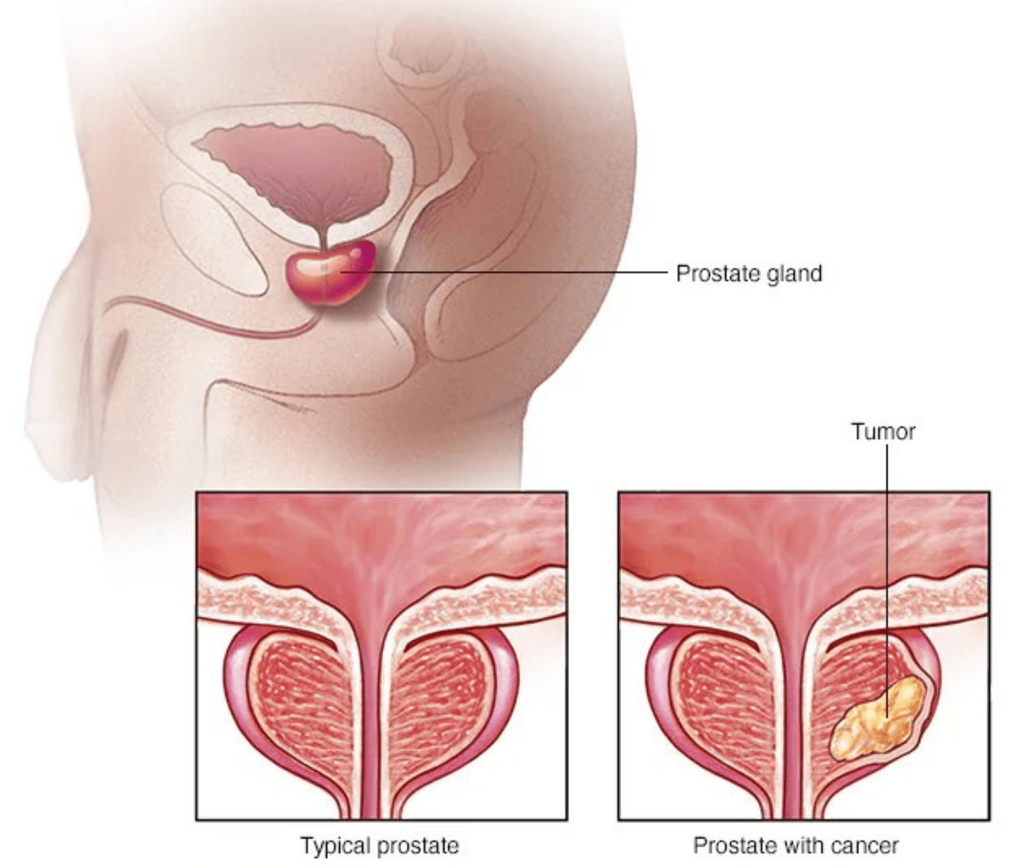 Prostate Cancer
