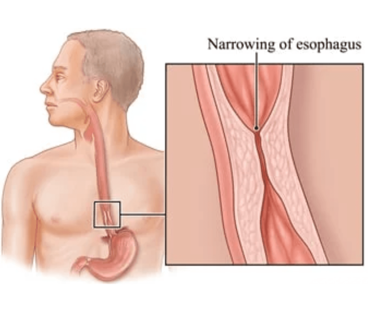 Stomach & Esophageal Cancer